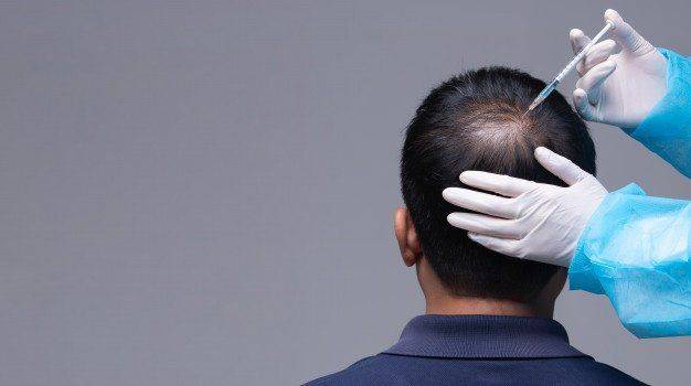 Hair transplant The definitive solution