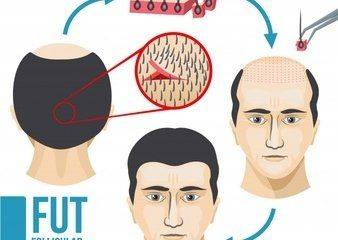 Μεταμόσχευση μαλλιών: Η οριστική λύση.