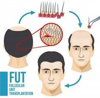 Hair transplant The definitive solution